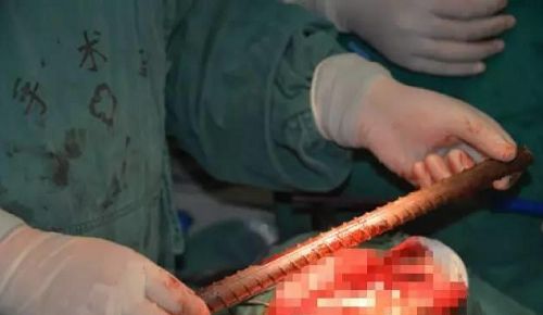 驚險！濱州一小伙嘴里插進1.5米鋼筋 濱醫(yī)附院多科室聯(lián)合手術3小時取出