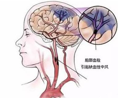 心腦血管疾病是心臟血管和腦血管疾病的統(tǒng)稱(chēng)，泛指由于高脂血癥、血液黏稠、動(dòng)脈粥樣硬化、高血壓等所導(dǎo)致的心臟、大腦及全身組織發(fā)生的缺血性或出血性疾病。心腦血管疾病是一種嚴(yán)重威脅人類(lèi)，特別是50歲以上中老年人健康的常見(jiàn)病，具有高患病率、高致殘率和高死亡率的特點(diǎn)。