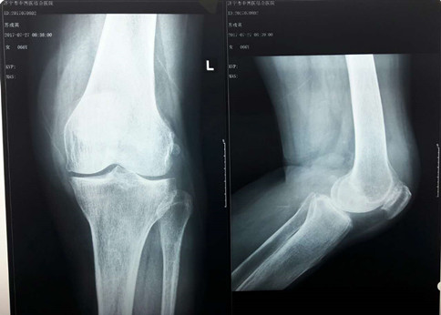 新突破  濟寧市中西醫(yī)結合醫(yī)院成功完成首例人工膝關節(jié)置換手術