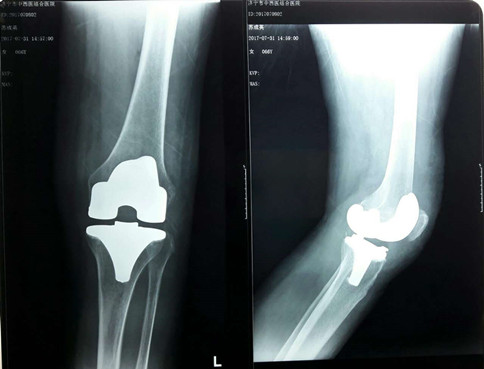 新突破  濟寧市中西醫(yī)結合醫(yī)院成功完成首例人工膝關節(jié)置換手術