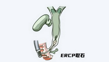 病程短、負(fù)擔(dān)輕！山東大學(xué)齊魯醫(yī)院德州醫(yī)院肝膽外科在中心院區(qū)復(fù)合手術(shù)室一次性完成兩項(xiàng)手術(shù)